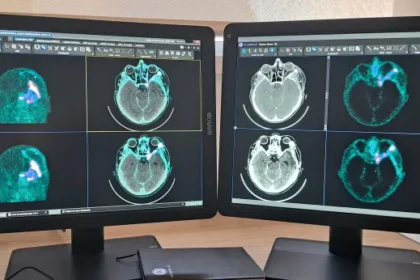 Imágenes de un PET (tomografía de emisión de positrones) de un tumor cerebral. Foto cedida por el Hospital 12 de Octubre de Madrid.