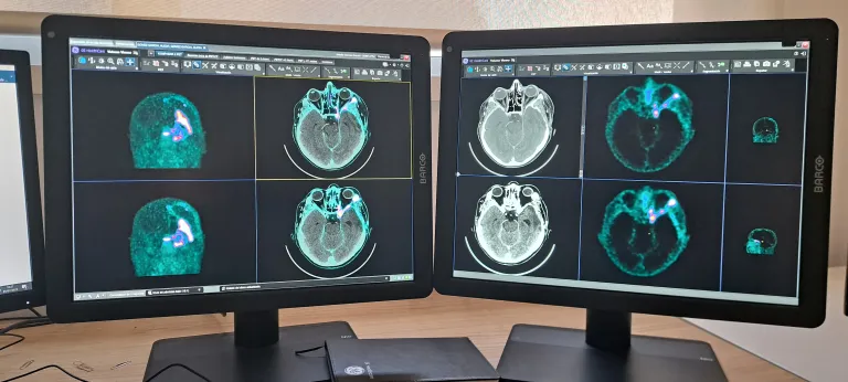Imágenes de un PET (tomografía de emisión de positrones) de un tumor cerebral. Foto cedida por el Hospital 12 de Octubre de Madrid.